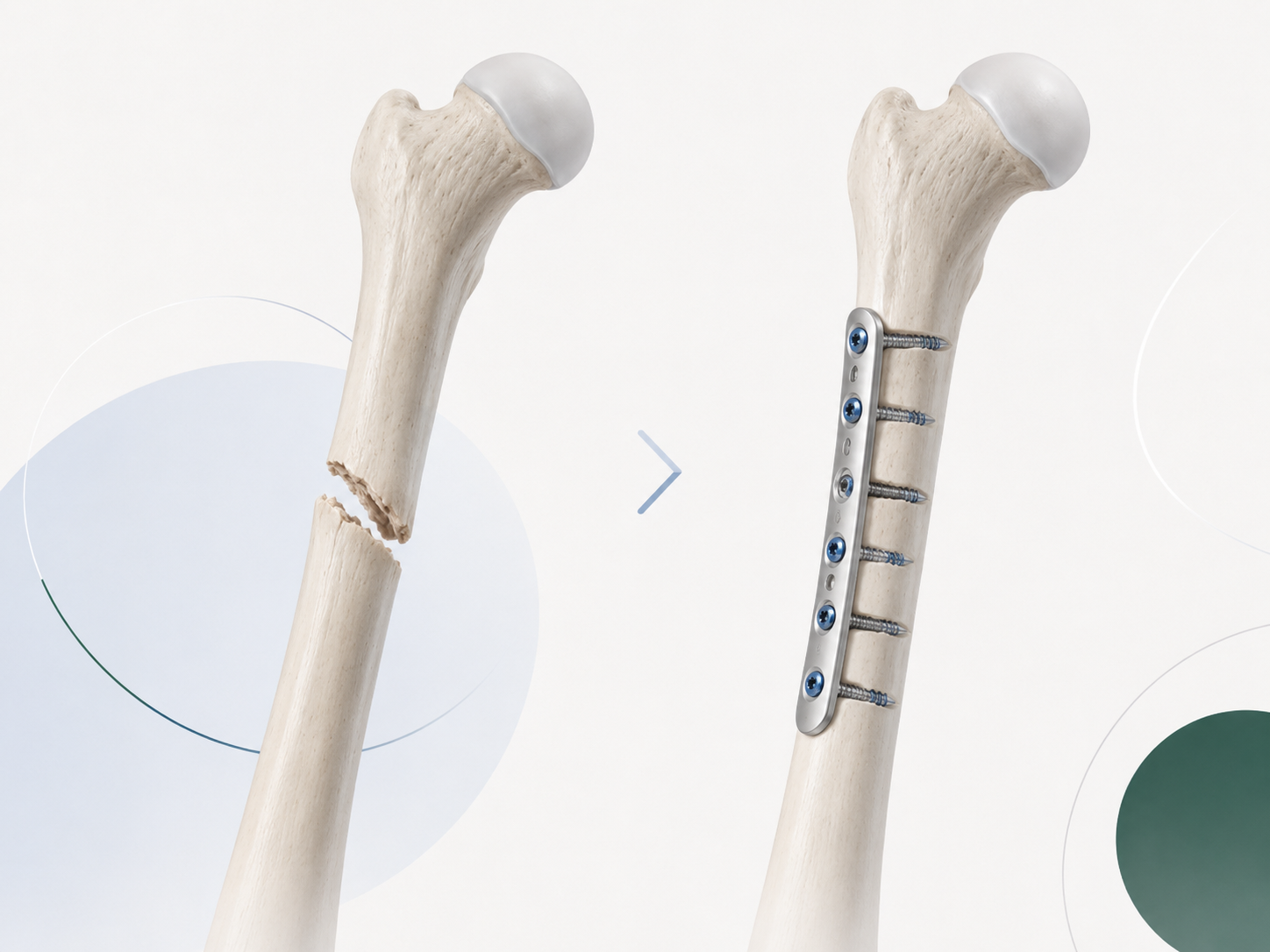 Fracture fixation and orthopedic trauma treatment